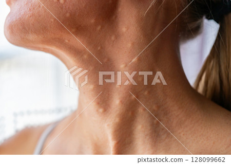 Woman's face after mesotherapy injections biorevitalization. Woman's face after mesotherapy injections biorevitalization. 128099662