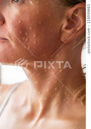 Woman's face after mesotherapy injections biorevitalization. Woman's face after mesotherapy injections biorevitalization. 128099663