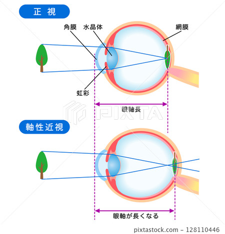 Structure of the eye: normal vision and axial myopia, visual acuity 128110446