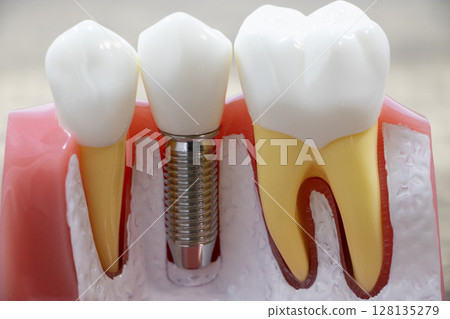Implant 128135279