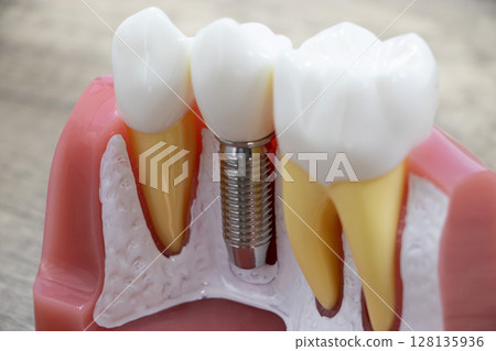 Implant 128135936