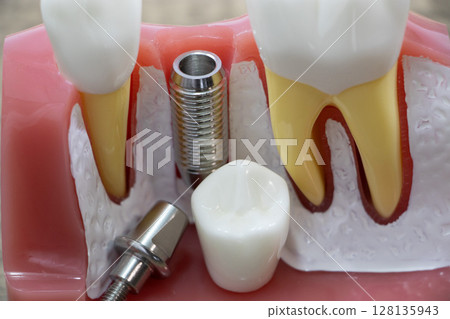 Implant Implant 128135943