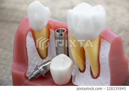 Implant Implant 128135945