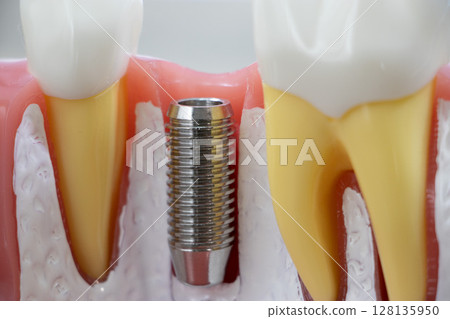 Implant Implant 128135950