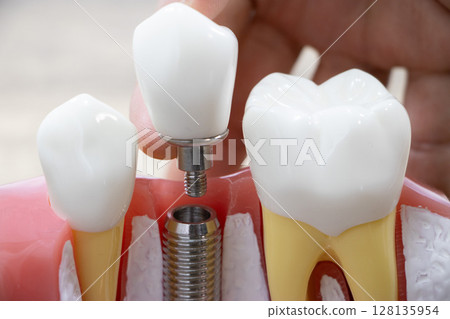 Implant Implant 128135954