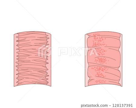 消化系統的解剖學和生理學:空腸和迴腸環形皺襞,無文字 消化系統的解剖學和生理學:空腸和迴腸環形皺襞,無文字 128137391