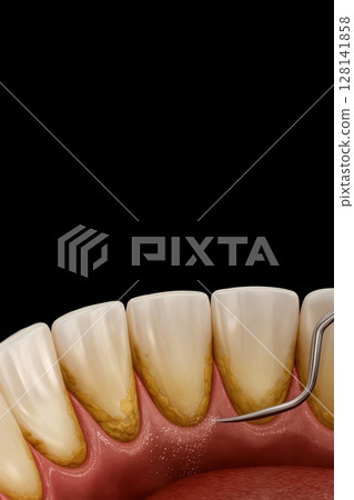 Detailed view of teeth with tartar buildup being professionally cleaned using dental scaler 128141858