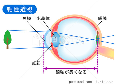 眼睛的結構、軸心近視、視力 128149098