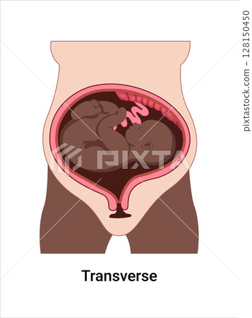 Transverse baby positions in the uterus during pregnancy. Dark-skinned woman. Pathology. Detailed medical vector illustration. Fetus with umbilical cord, placenta. 128150450