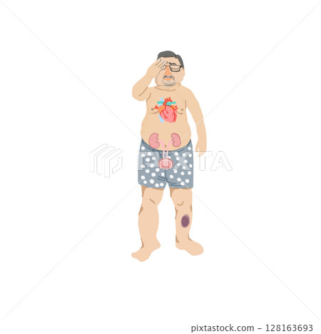 A middle-aged man with physical findings of diabetic complications (illustration material) 128163693