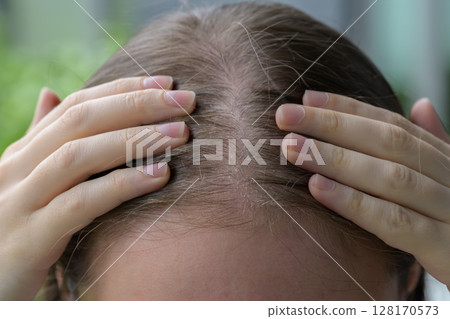 Close up of a woman parting hair to reveal a dry, irritated scalp with visible flakes. Concept of scalp health, dermatology, dandruff, haircare, discomfort and sensitive skin condition. Close up of a woman parting hair to reveal a dry, irritated scalp with visible flakes. Concept of scalp health, dermatology, dandruff, haircare, discomfort and sensitive skin condition. 128170573