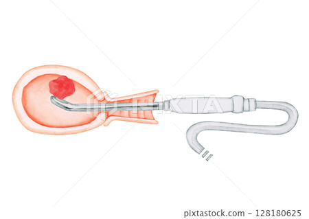 流產墮胎手術 EVA 自動抽吸水彩插圖 128180625