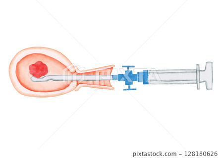 流產墮胎手術 MVA 手動真空抽吸水彩插圖 128180626