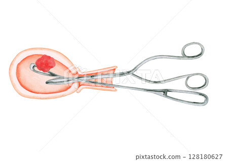 Miscarriage Abortion Surgery Curettage Watercolor Illustration Miscarriage Abortion Surgery Curettage Watercolor Illustration 128180627