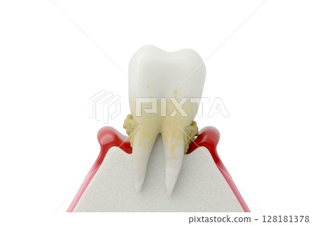 Illustration of severe periodontal disease, terminal symptoms of alveolar bone resorption and loose teeth Illustration of severe periodontal disease, terminal symptoms of alveolar bone resorption and loose teeth 128181378