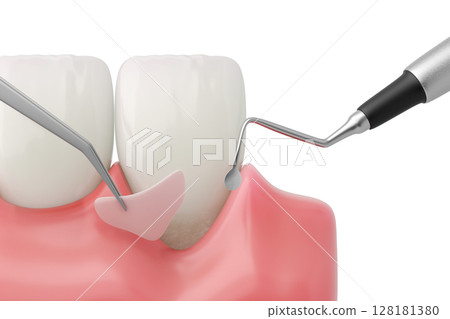 3DCG 圖解:牙齦移植治療牙周病引起的牙齦萎縮 3DCG 圖解:牙齦移植治療牙周病引起的牙齦萎縮 128181380