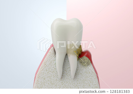 Comparison image of healthy gums and periodontal disease Concept illustration before and after Comparison image of healthy gums and periodontal disease Concept illustration before and after 128181383