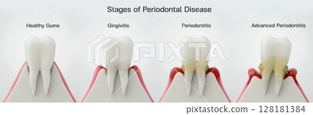 Illustration showing the stages of periodontal disease progression. Comparison diagram from healthy gums to severe. Illustration showing the stages of periodontal disease progression. Comparison diagram from healthy gums to severe. 128181384