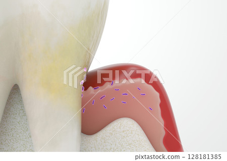 牙周病的原因 牙周病的3DCG 牙齦中生長的細菌和牙菌斑 128181385