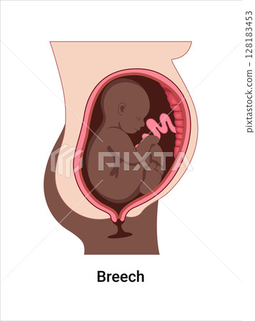 Breech baby positions in the uterus during pregnancy. Dark-skinned woman. Pathology. Detailed medical vector illustration. Fetus with umbilical cord, placenta. Breech baby positions in the uterus during pregnancy. Dark-skinned woman. Pathology. Detailed medical vector illustration. Fetus with umbilical cord, placenta. 128183453