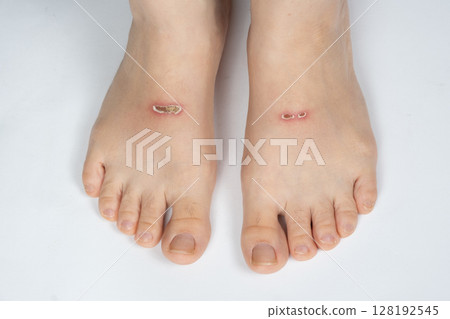 Wounds on Top of Feet from Flippers Friction After First Swimming with Fins 128192545