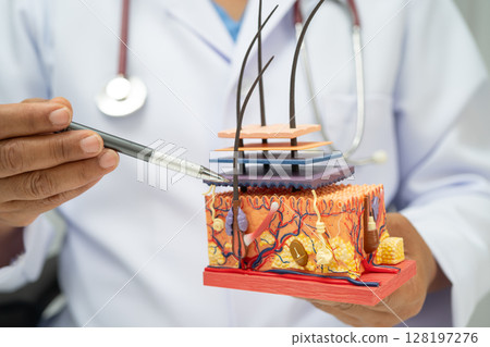 Hair transplant, Asian dermatologist doctor holding skin structure anatomy model for treatment in hospital. 128197276