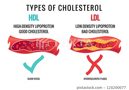 Types of cholesterol in human blood vessels. Normal and narrowed artery for explanation diseases. High-Density Lipoprotein HDL and Low-Density Lipoprotein LDL. Vector illustration Types of cholesterol in human blood vessels. Normal and narrowed artery for explanation diseases. High-Density Lipoprotein HDL and Low-Density Lipoprotein LDL. Vector illustration 128200077