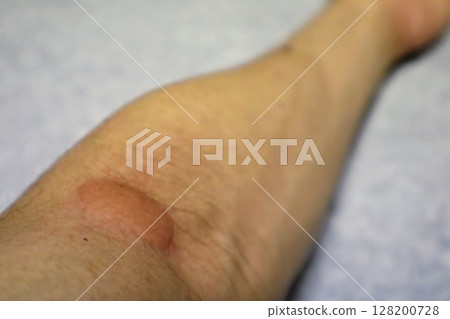 Close-up of an arm with mosquito bites 128200728
