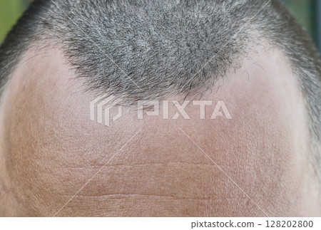 A close up view showcases a receding hairline on a man's head A close up view showcases a receding hairline on a man's head 128202800