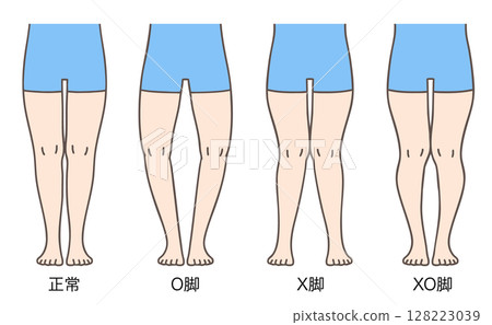 正常腿、羅圈腿、膝內翻和膝外翻的姿勢和比例 128223039