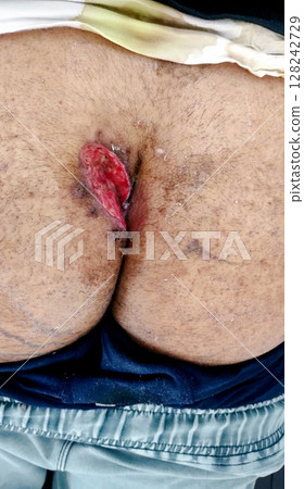Post-Surgical Wound After Pilonidal Sinus Excision Surgery Post-Surgical Wound After Pilonidal Sinus Excision Surgery 128242729