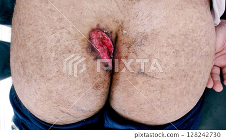 Post-Surgical Wound After Pilonidal Sinus Excision Surgery 128242730