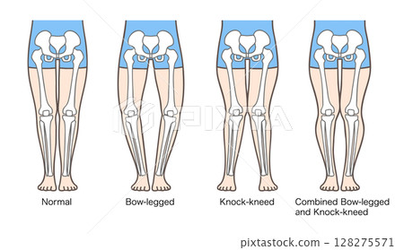 Posture and skeleton of normal legs, bow legs, knock-knees and knock-knees Posture and skeleton of normal legs, bow legs, knock-knees and knock-knees 128275571