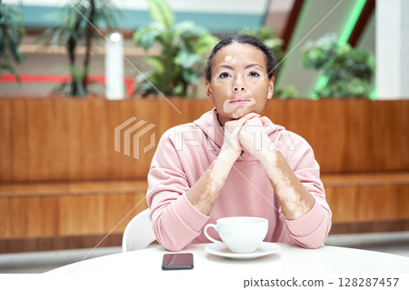 Black african american woman with vitiligo 128287457