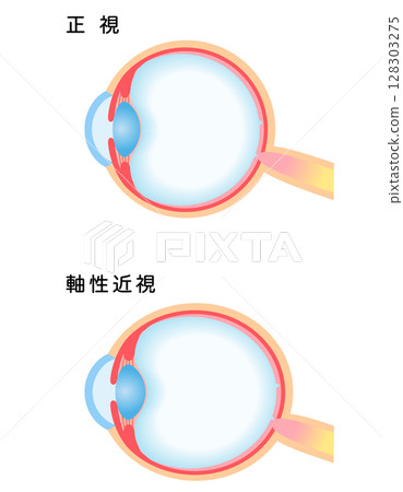Structure of the eye: normal vision and axial myopia, visual acuity 128303275