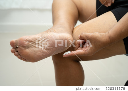 Asian woman care feet with cracked and dry heel skin cream at home. Asian woman care feet with cracked and dry heel skin cream at home. 128311176