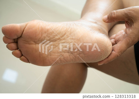 Asian woman check feet with crack and dry heel skin, Diabetic Foot. 128313318