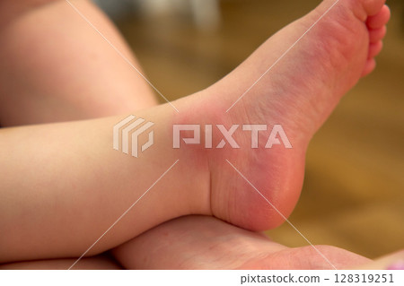 Holds a child foot that displays noticeable redness and swelling from a mosquito bite. Holds a child foot that displays noticeable redness and swelling from a mosquito bite. 128319251