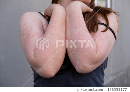 Psoriasis. Acute psoriasis of the elbows is an autoimmune incurable dermatological skin disease. It is characterized by extensive, red, inflamed, flaky rash. Psoriasis. Acute psoriasis of the elbows is an autoimmune incurable dermatological skin disease. It is characterized by extensive, red, inflamed, flaky rash. 128353177