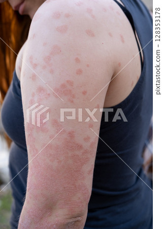 Psoriasis. Acute psoriasis of the hands, wrists, elbows is an autoimmune incurable dermatological skin disease. It is characterized by extensive, red, inflamed, flaky rash. Psoriasis. Acute psoriasis of the hands, wrists, elbows is an autoimmune incurable dermatological skin disease. It is characterized by extensive, red, inflamed, flaky rash. 128353178