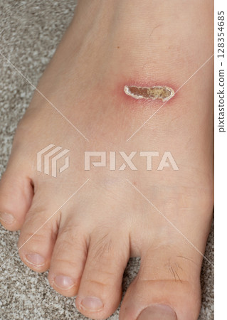 Abrasions on Top of Feet After Swimming with Fins Abrasions on Top of Feet After Swimming with Fins 128354685
