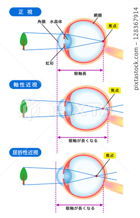 Structure of the eye, normal vision, axial myopia, refractive myopia, visual acuity Structure of the eye, normal vision, axial myopia, refractive myopia, visual acuity 128367914
