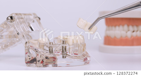 Dental implant placement with prosthetic bridge 128372274