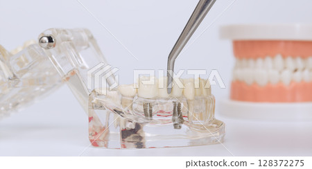 Placing dental crown on implant model 128372275