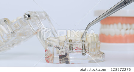 Placing dental crown on implant model Placing dental crown on implant model 128372276