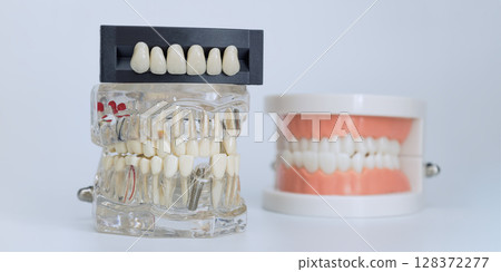 Dental implant model with artificial teeth display Dental implant model with artificial teeth display 128372277