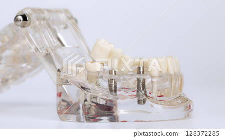 Dental implant bridge fitting on jaw model Dental implant bridge fitting on jaw model 128372285