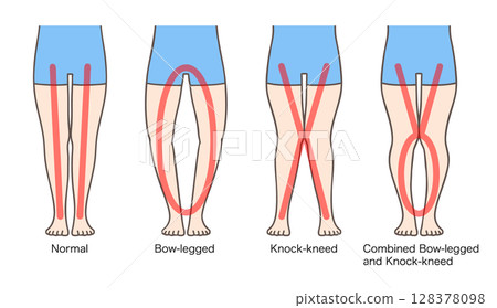 正常腿、O型腿、膝蓋內翻、XO型腿、女性小腿 正常腿、O型腿、膝蓋內翻、XO型腿、女性小腿 128378098