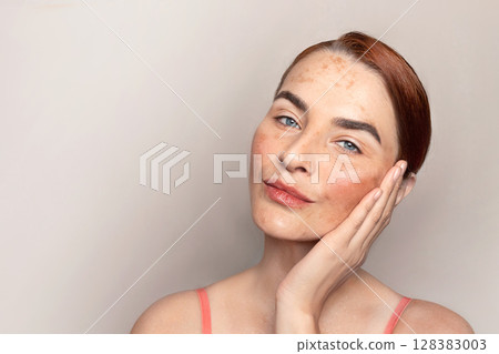 Caucasian woman face with pigmentation, melasma, freckles, age spots photo. Copy space photo Caucasian woman face with pigmentation, melasma, freckles, age spots photo. Copy space photo 128383003