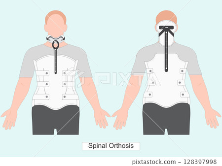 Milwaukee brace or TLSO is a rigid spinal Orthosis. 128397998